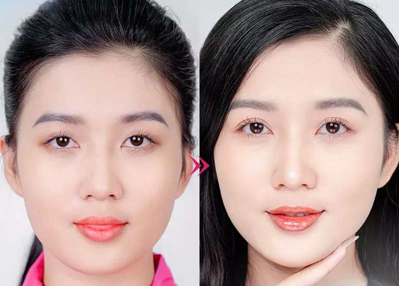 Cắt mí phượng hoàng là gì? 7 nhung hinh anh cat mi mat 10 e1758695069215