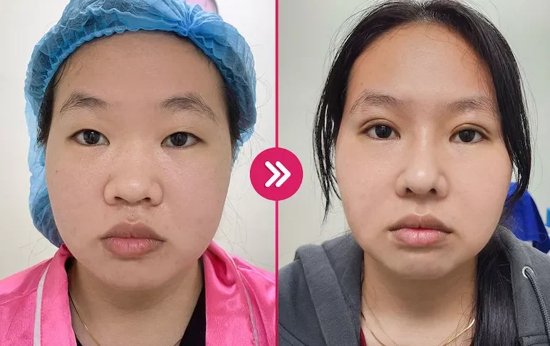 Cắt mí phượng hoàng là gì? 10 nhung hinh anh cat mi mat 13 e1758695185399