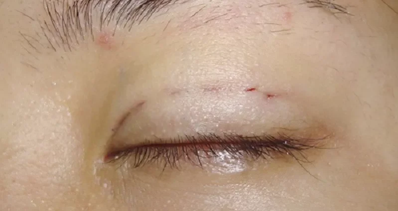 Cắt mí size 5, 6, 7, 8, 9 to hay nhỏ? 7 nhung hinh anh cat mi mat 7 e1758694922526