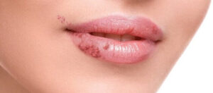 Phun môi bị mụn nước xử lý thế nào để không để lại thâm sẹo?