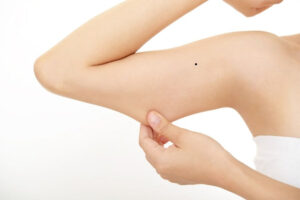 Nốt ruồi ở cánh tay là một hiện tượng sinh lý bình thường
