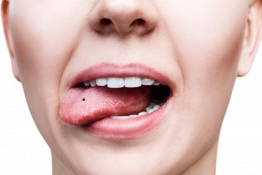 Nốt ruồi ở lưỡi tốt hay xấu và có nên tẩy hay không? 1 Nốt ruồi ở lưỡi tốt hay xấu và có nên tẩy hay không?