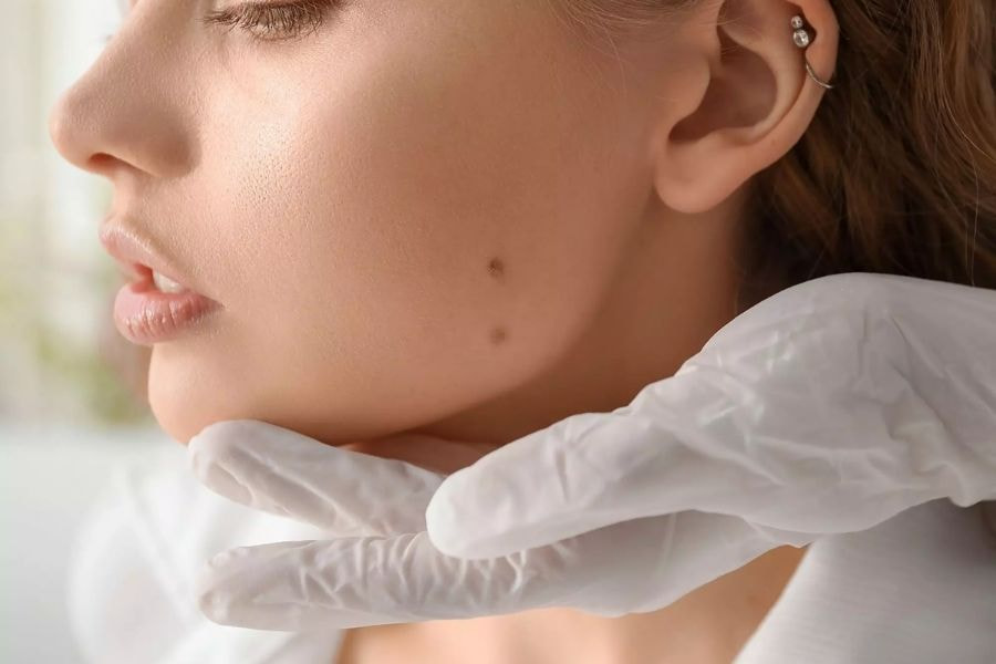 Nốt ruồi trên mặt có ý nghĩa gì? Bật mí điều ít ai biết