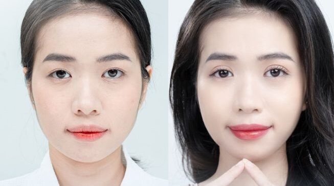 Lấy mỡ da thừa mí trên 5 o6RTvZ6Q dr eye lay mo da thua mi tren 8 e1758725413779