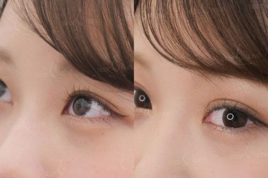 Liệu phun mí mở tròng có hợp với dáng mắt của bạn? 1 Phun mí mở tròng là gì?