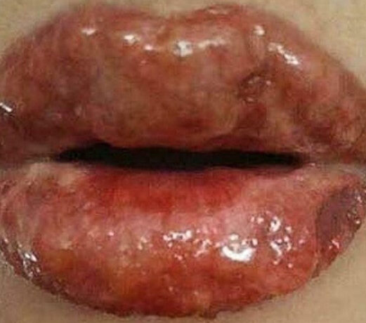 Nguyên nhân phun môi bị chảy nước mô và cách khắc phục 1 phun moi bi chay nuoc mo 1 1 e1757652086878