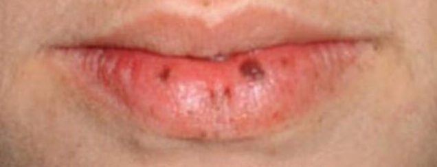 Phun môi bị đốm đen – Nguyên nhân và cách khắc phục ra sao? 5 phun moi bi dom den 8 e1757650969553