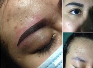 Phun lông mày bị mưng mủ