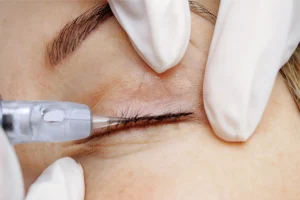 Mí mở tròng là gì?