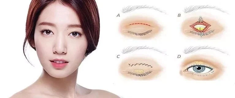 Cắt mí mini deep là gì? Có nên cắt mí mini deep? 4 quy trinh cat mi mini deep e1758622840926