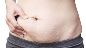 cách xóa rạn da sau sinh