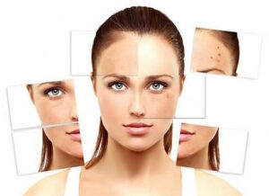 nám da, tàn nhang và sạm da