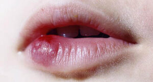 Xăm môi bị sẹo lồi