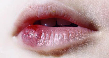 Xăm môi bị sẹo lồi phải làm sao? Cách khắc phục hiệu quả nhất 2 Xăm môi bị sẹo lồi