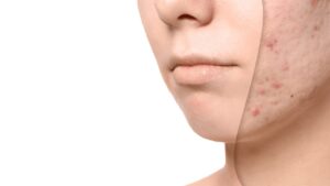 xóa sẹo thủy đậu