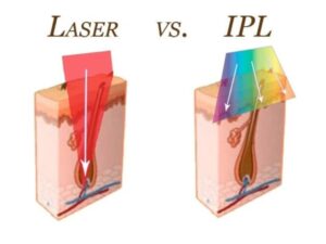 triệt lông Diode Laser và IPL