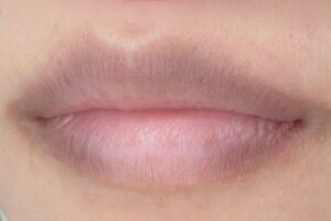 môi bị thâm loang