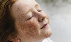 Tàn nhang bẩm sinh