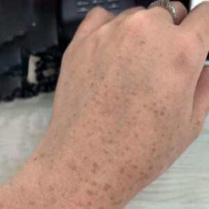 Tay nổi đốm nâu như đồi mồi