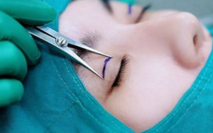 tim hieu ngay ve cac phuong phap phau thuat nang co mi mat 5 Cropped 036d6aa13f