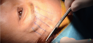 Treo chân mày bằng chỉ