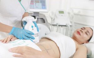 Triệt lông bụng