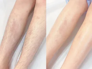 Triệt lông chân giá