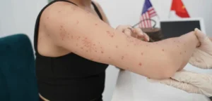 triệt lông xong bị viêm lỗ chân lông