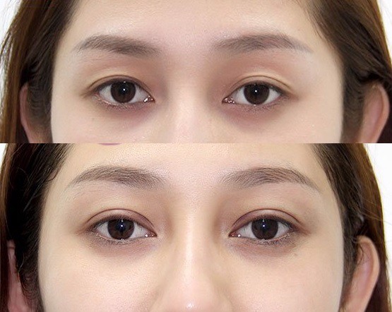 Top 12 địa chỉ cắt mí mắt đẹp uy tín tại TP. Hồ Chí Minh 5 unnamed 4