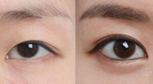 Mí sụp có nên phun mí không? Ưu điểm phương pháp phun mí