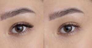 Tạo hình mí mắt trên