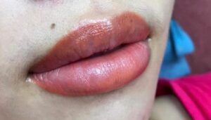 Môi phun hỏng vì chăm sóc sai 3 ngày đầu