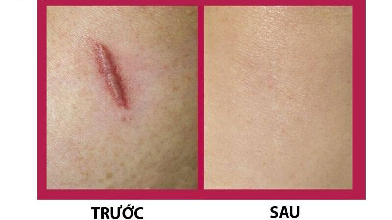 Xăm môi bị sẹo lồi phải làm sao? Cách khắc phục hiệu quả nhất 6 xam moi bi seo loi 7 66179138d4694 e1757750759435