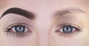 xoa chan may bang laser co het khong 3