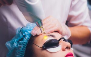 Xóa chân mày bằng công nghệ laser