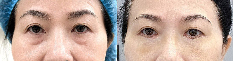 Xóa nhăn vùng mắt có những công nghệ nào? 6 xoa nhan vung mat gia bao nhieu 12 e1758858332888