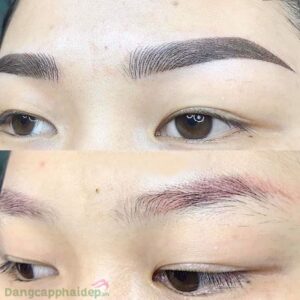 Xoá xăm chân mày bằng laser