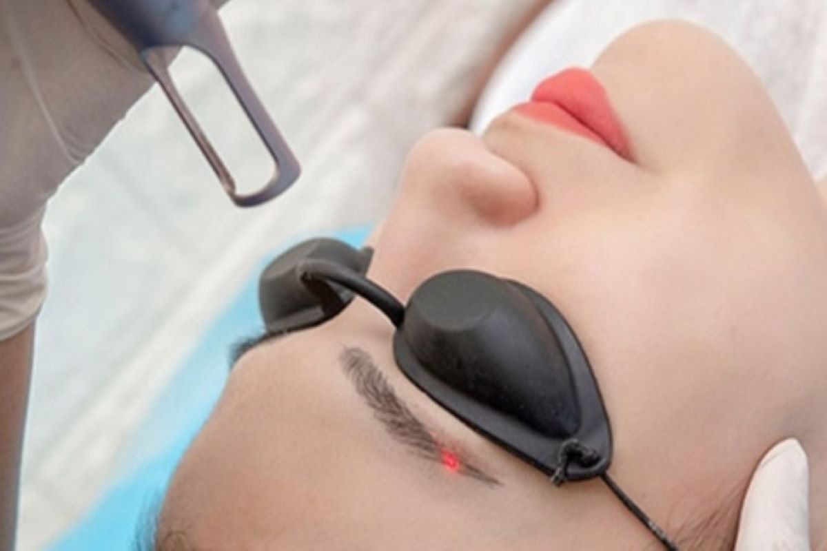 Cách chăm sóc lông mày sau khi xóa laser Cách chăm sóc lông mày sau khi xóa laser