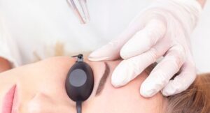 Xoá xăm lông mày bằng Laser có để lại sẹo không?