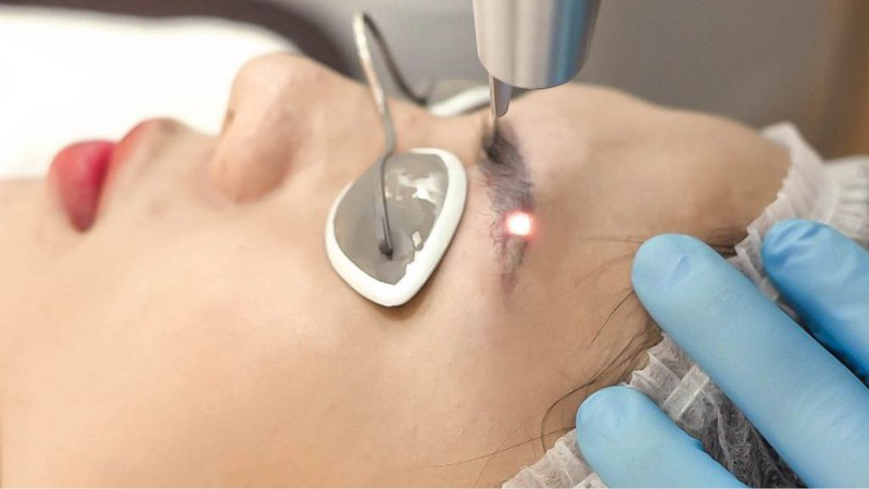 Xóa Xăm Chân Mày Bằng Laser Xóa Xăm Chân Mày Bằng Laser