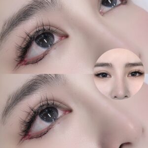 Mở góc mắt giọt lệ Trung Hoa là gì? Có để lại sẹo không?