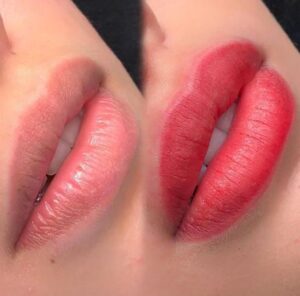 Khử thâm môi nữ bao lâu thì được ăn uống bình thường?