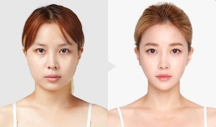 Tiêm filler môi là gì?