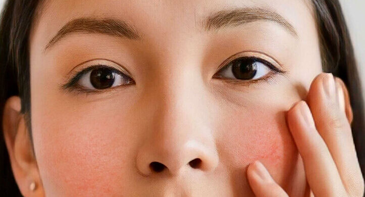 Khi mí phun bị kích ứng nhẹ nhưng không bị viêm – xử lý tại nhà