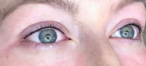 Vì sao mí phun xong lại bị sưng lệch hai bên?