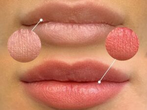 So sánh phun khử thâm thường và khử thâm siêu vi điểm