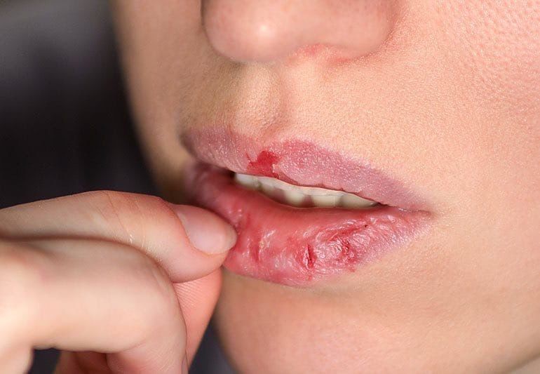 Môi bị nứt chảy máu có phun môi được không? 1 Môi bị nứt chảy máu có phun môi được không?