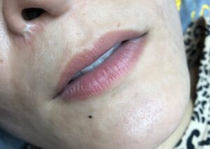 Môi khử xong bị sậm lại sau 1 tháng – nguyên nhân thật sự là gì?