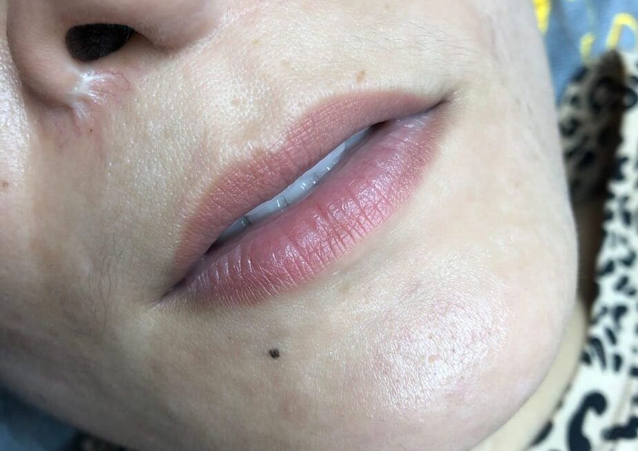 Môi khử xong bị sậm lại sau 1 tháng – nguyên nhân thật sự là gì?