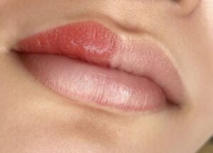 Khử thâm môi công nghệ Nano Collagen là gì?